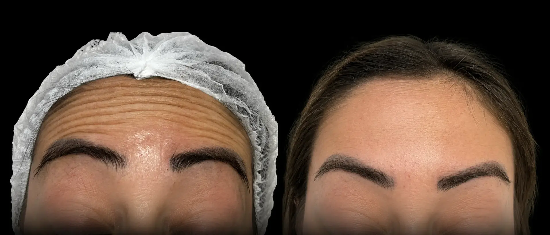 Antes e depois de botox e harmonização orofacial
