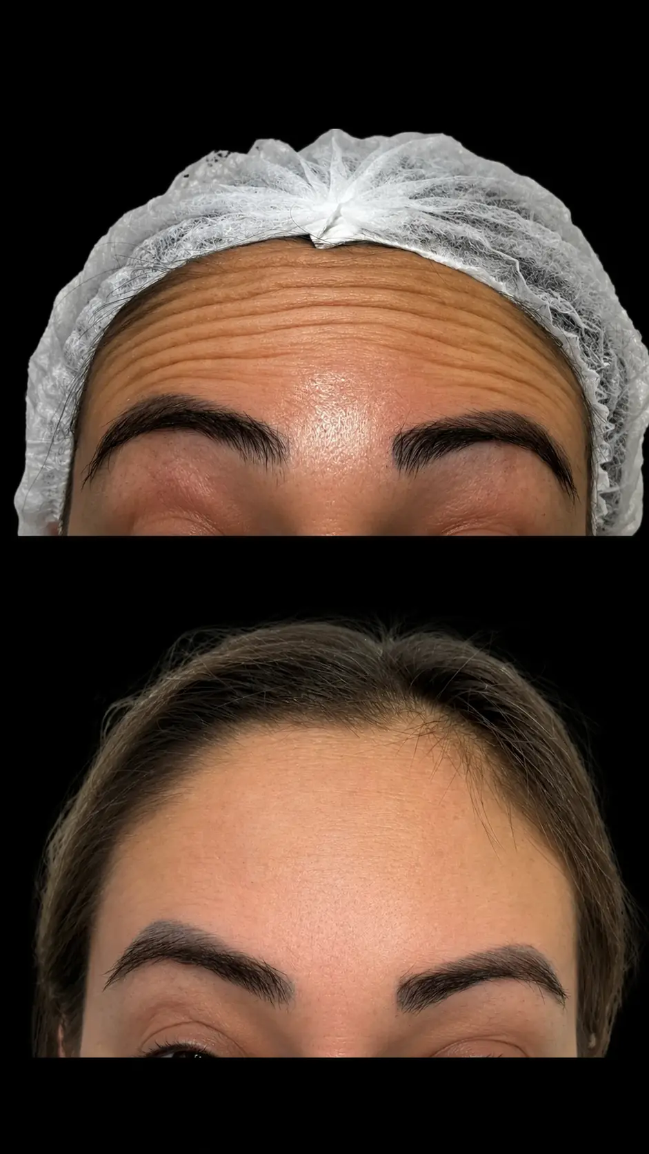 Antes e depois de botox e harmonização orofacial