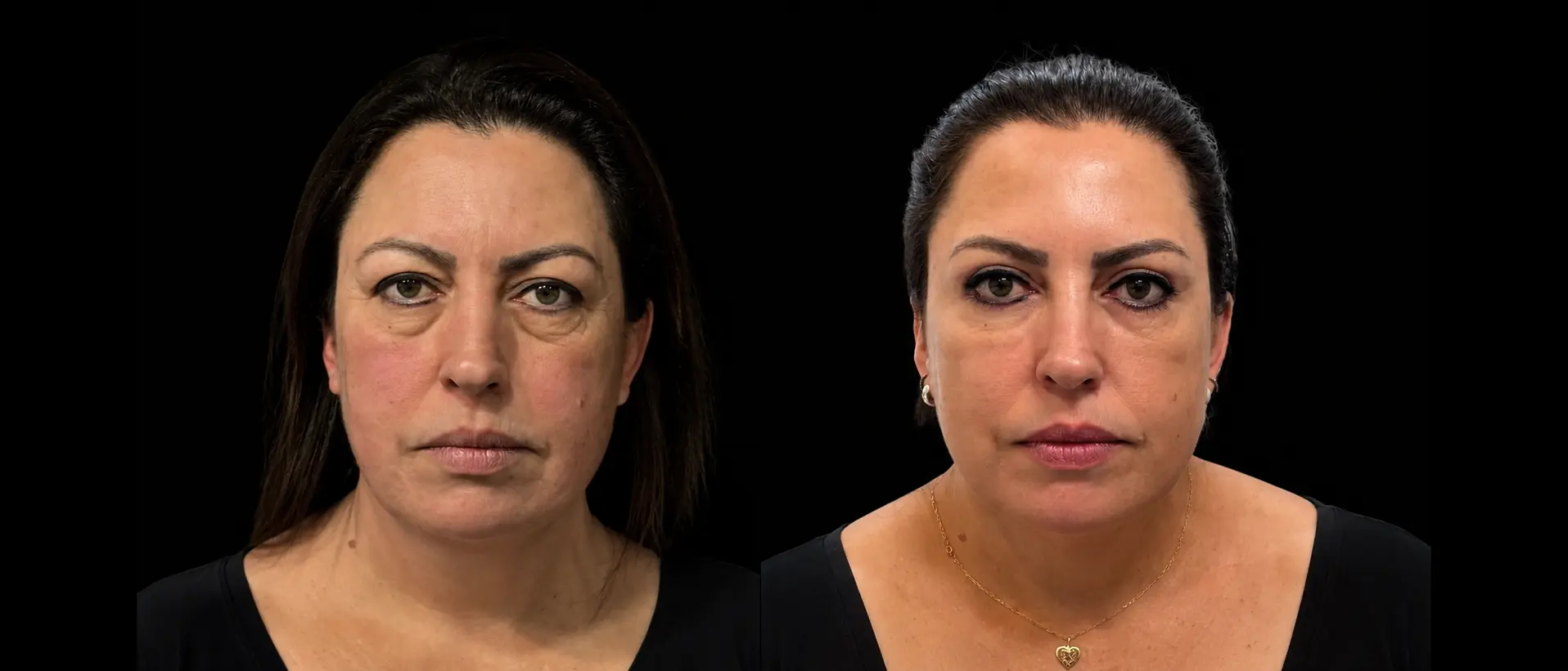 Antes e depois de lifting de pálpebras