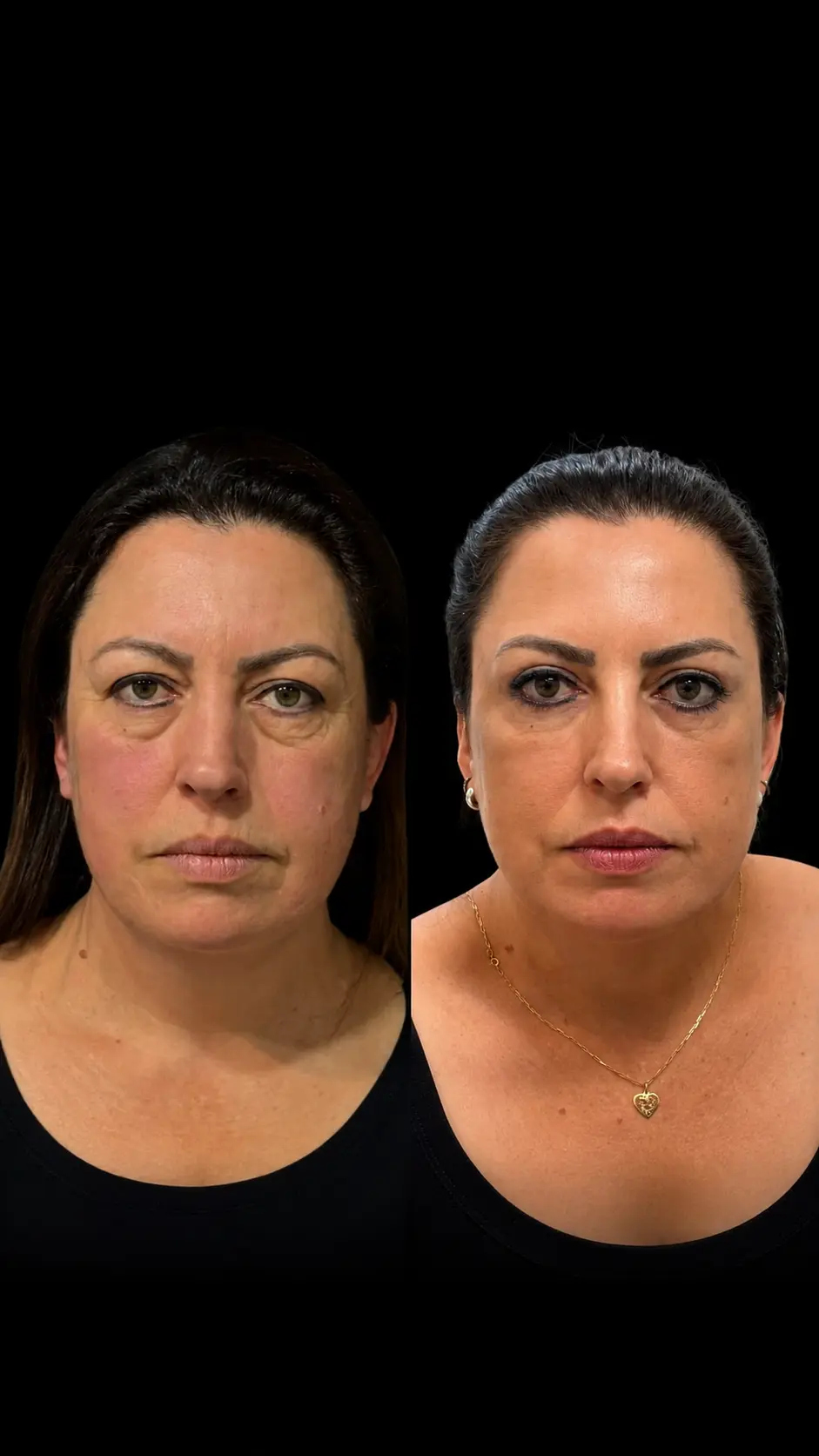 Antes e depois de lifting de pálpebras