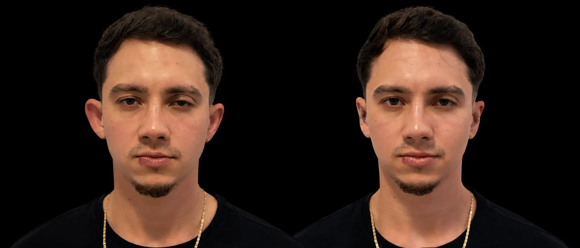 Antes e depois de otomodelação