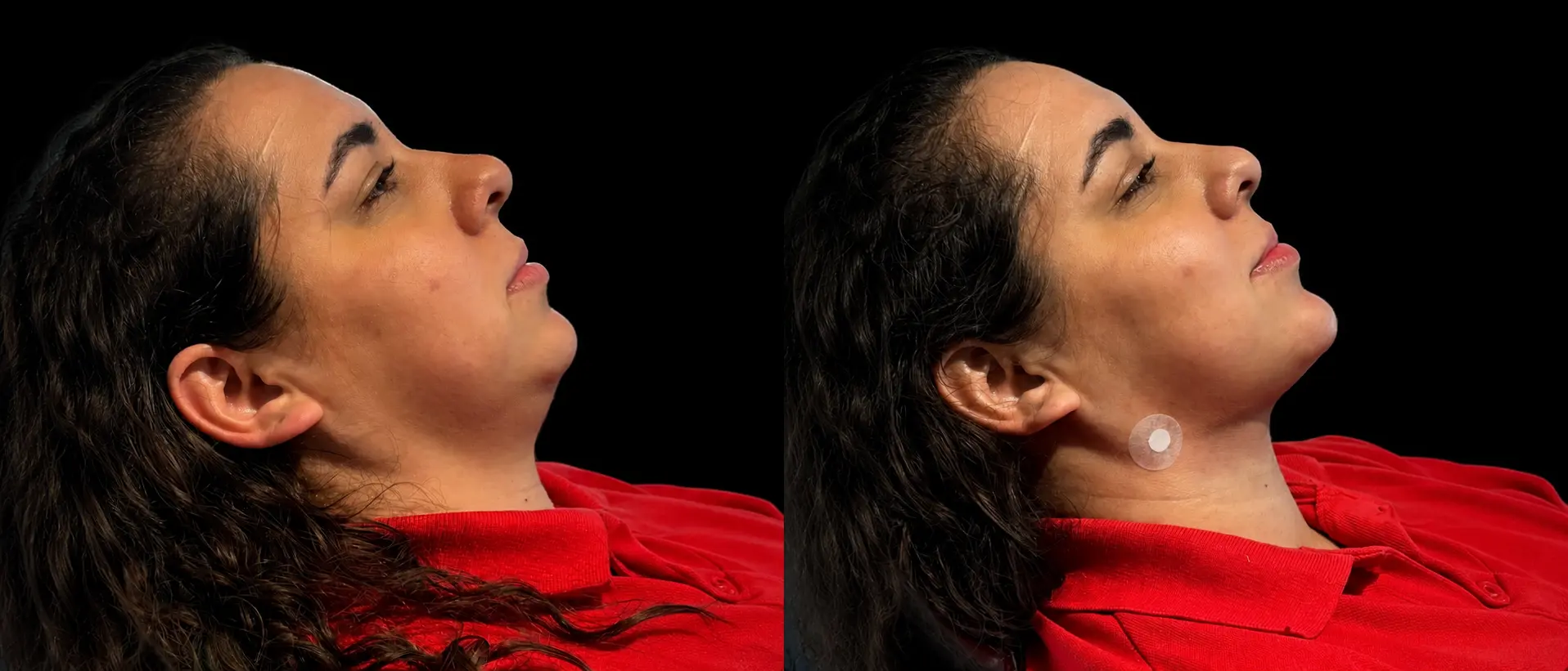 Antes e depois de lipo de papada