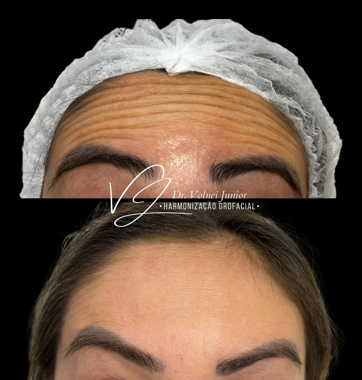 Resultado Botox 1