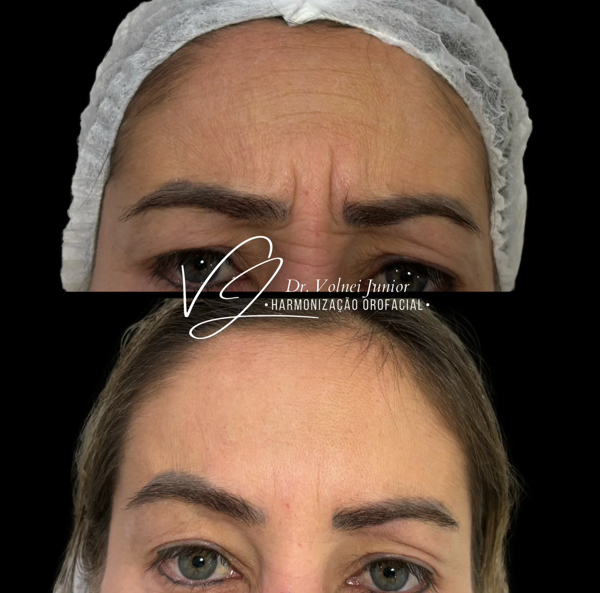Resultado Botox 2
