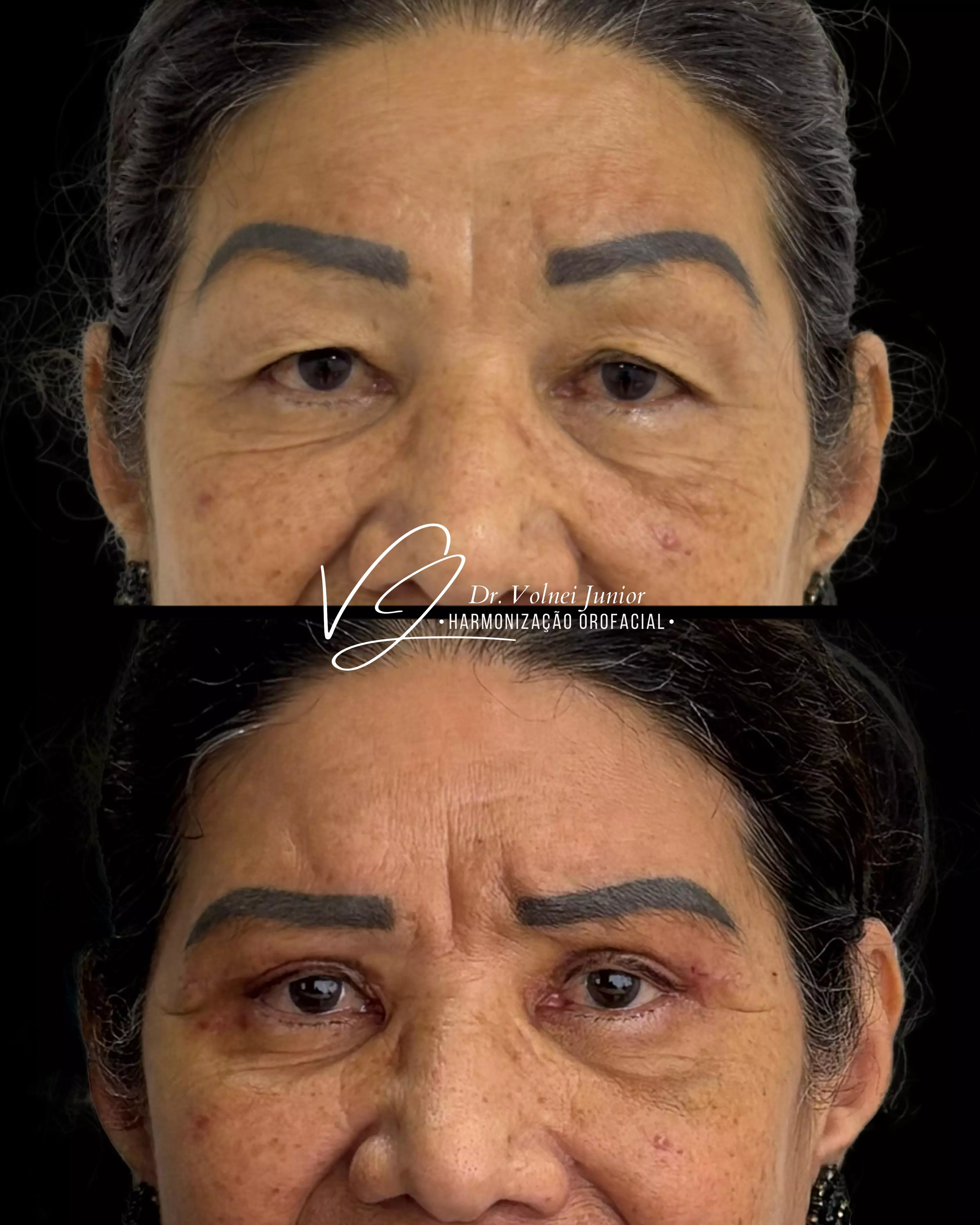 Resultado Pálpebras 3