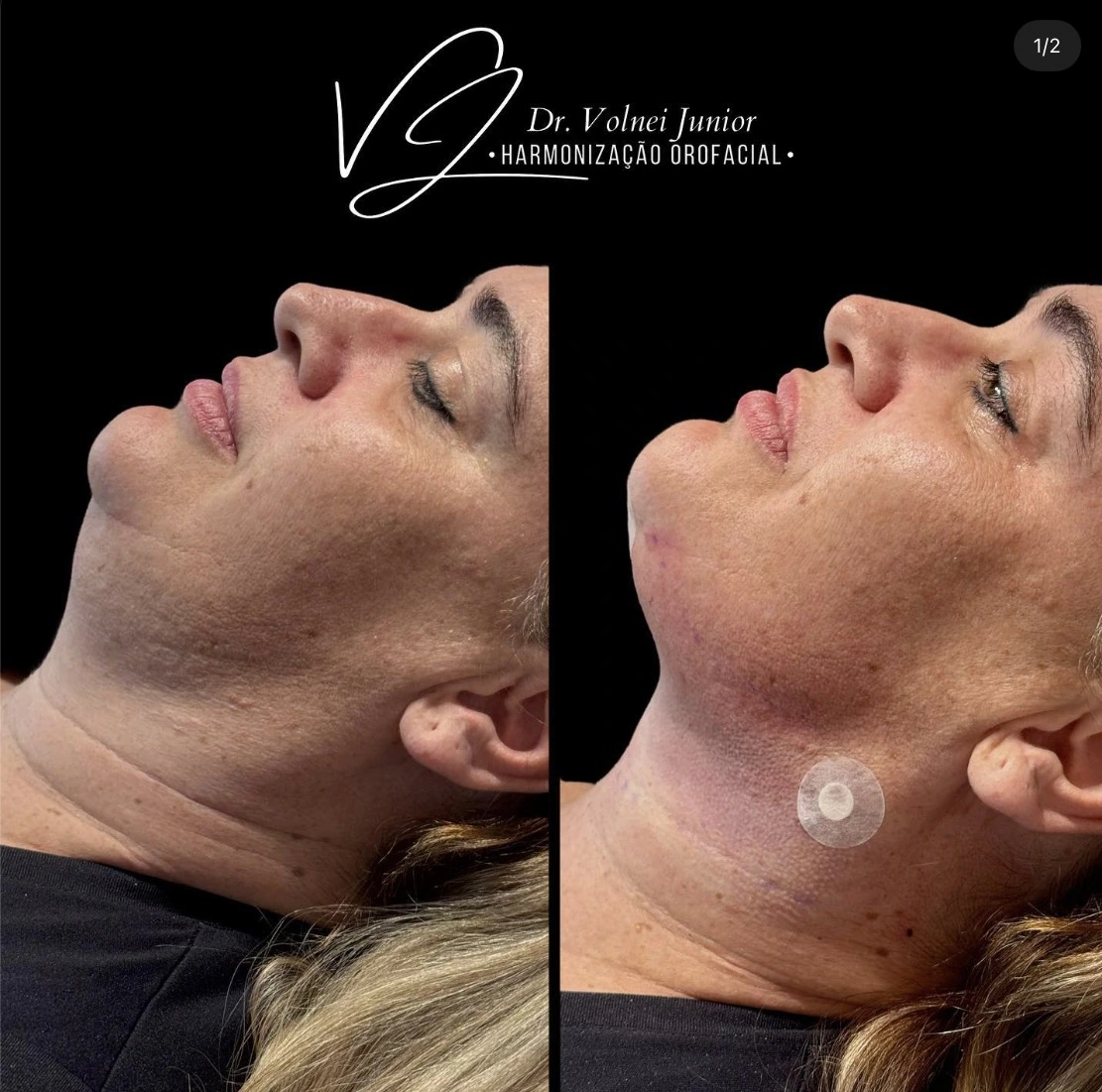 Resultado de lipo de papada 3